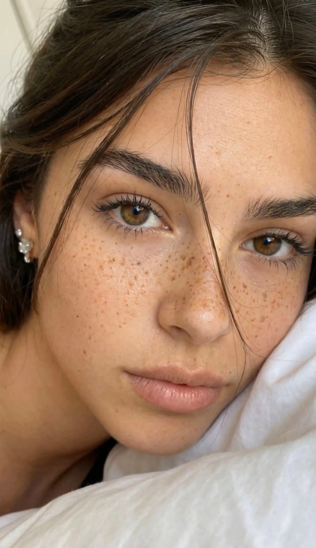 Freckles Pigmentierung-1